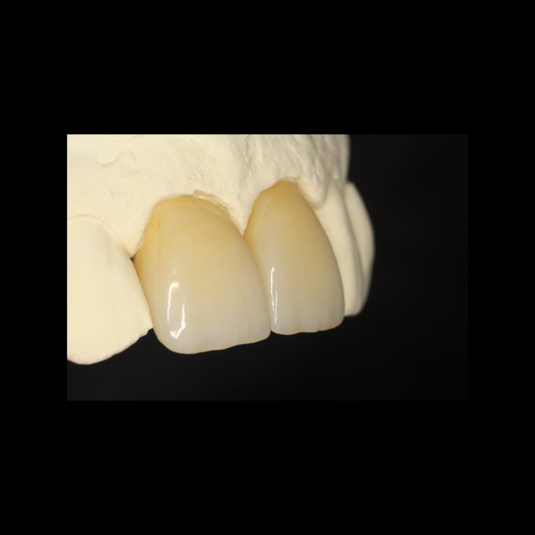 Zirconia crown restoration
